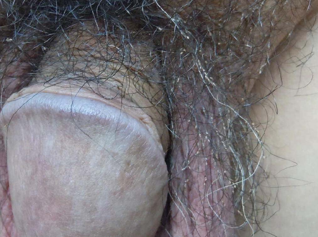 虱病
